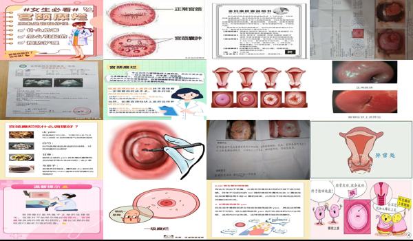 宫颈糜烂有颗粒状 - 汕头宫颈糜烂看到细颗粒状
