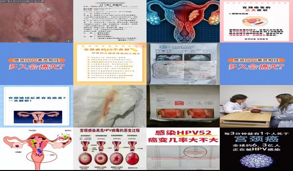宫颈腐烂三度应该怎么治疗好? - 汕头宫颈3度腐烂多久*变