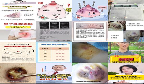 乳头烂了里面的乳腺疼 - 汕头乳腺烂肿为什么这么疼