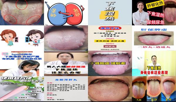 妇科病是下焦湿热吗 - 汕头妇科炎症是下焦湿热吗