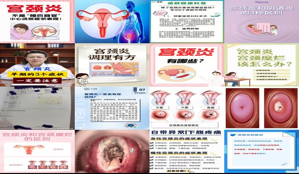 汕头中度宫颈炎有哪些证状可以治疗 - 汕头中度宫颈炎有哪些证状