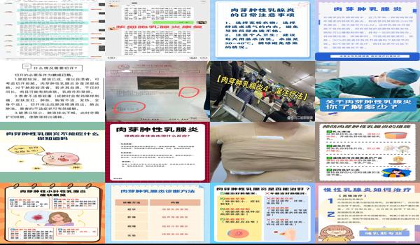 乳头肉芽肿症状 - 汕头肉芽性乳腺炎怎么治疗