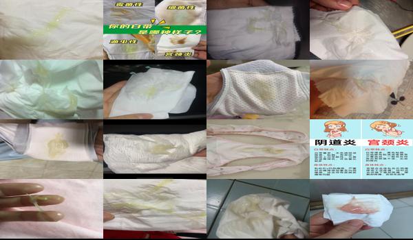 宫颈炎有白色分泌物 - 汕头宫颈炎白带