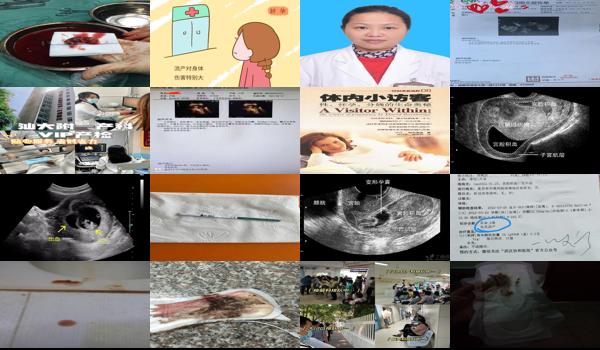 汕头怀孕12周宫腔积血容易流产吗多少钱 - 汕头怀孕12周宫腔积血容易流产吗