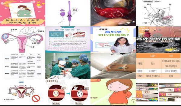 汕头中心医院宫外孕手术多少钱 - 汕头宫外孕流产的方法
