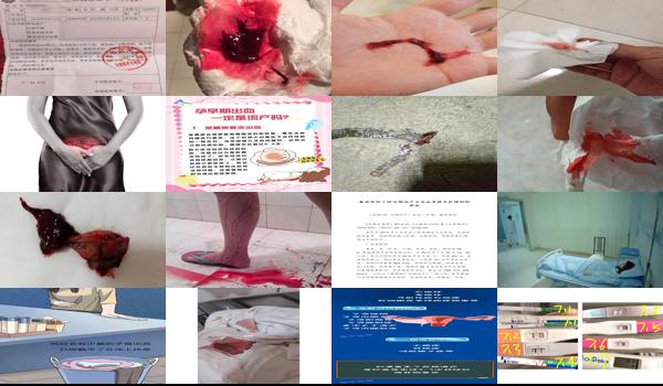汕头流产要多少钱 - 汕头流产出血大怎么办