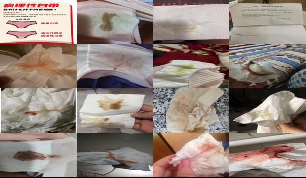 女人上环下面有血怎么回事 - 汕头女人上环后白带有血丝