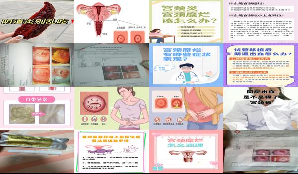 轻微宫颈糜烂治疗要多少钱 - 汕头轻微宫颈糜烂怎么办啊
