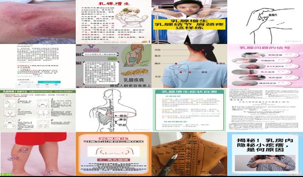 拔火罐对乳腺增生有好处吗 - 汕头拔火罐会加重乳腺增生吗