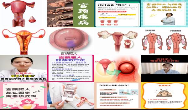 宫颈头肥大是有什么治疗方法 - 汕头子宫颈肥大是怎么回事