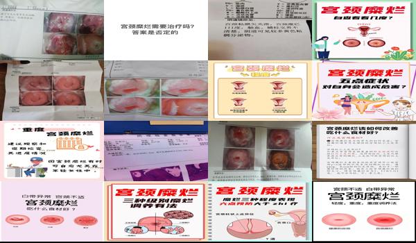 汕头重度宫颈糜烂治疗要多少钱费用 - 汕头重度宫颈糜烂治疗要多少钱