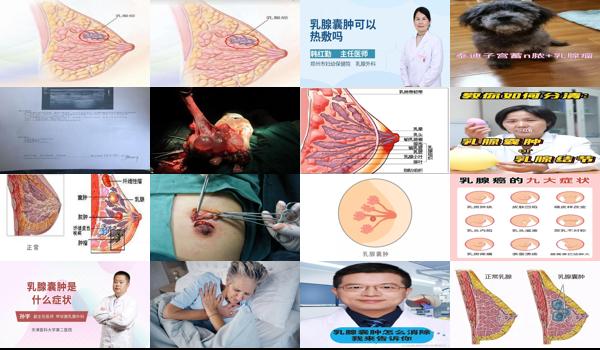 汕头乳腺*症状医生 - 汕头乳腺*症状
