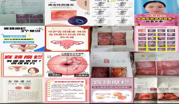 汕头宫颈糜烂腰肿*医院 - 汕头宫颈糜烂腰肿