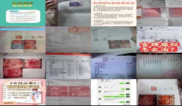 汕头宫颈糜烂检查项目有哪些 - 汕头宫颈糜烂检查项目